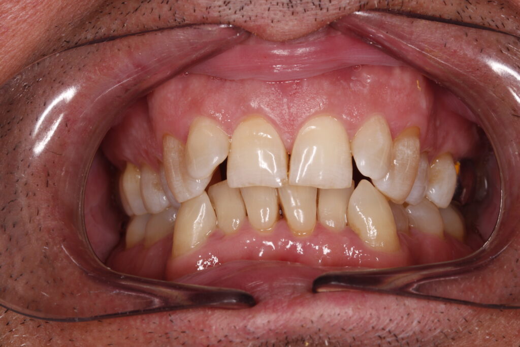 Caso clínico de apiñamiento dental severo antes del tratamiento de ortodoncia en Llíria.⁠