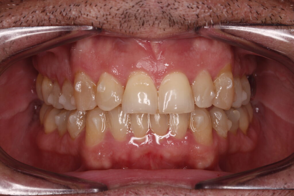 Resultado final de alineación dental tras tratamiento de ortodoncia en Miguel Pérez Odontología Llíria.