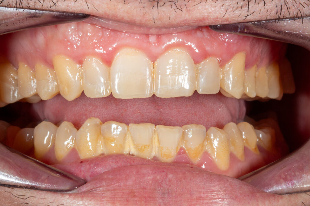 ⁠Caso clínico de dientes desgastados antes del tratamiento de estética dental en Llíria.⁠