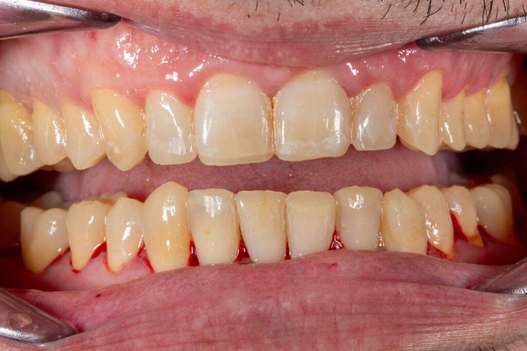 Resultado final de estética dental con reconstrucciónes de composite inyectado en Miguel Pérez Odontología Llíria.⁠