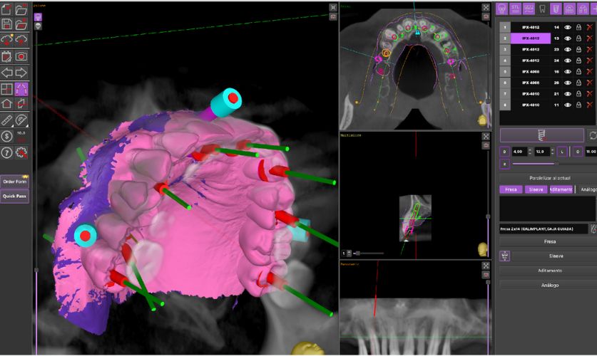 Planificación digital y cirugía guiada por ordenador para implantes dentales en Llíria.