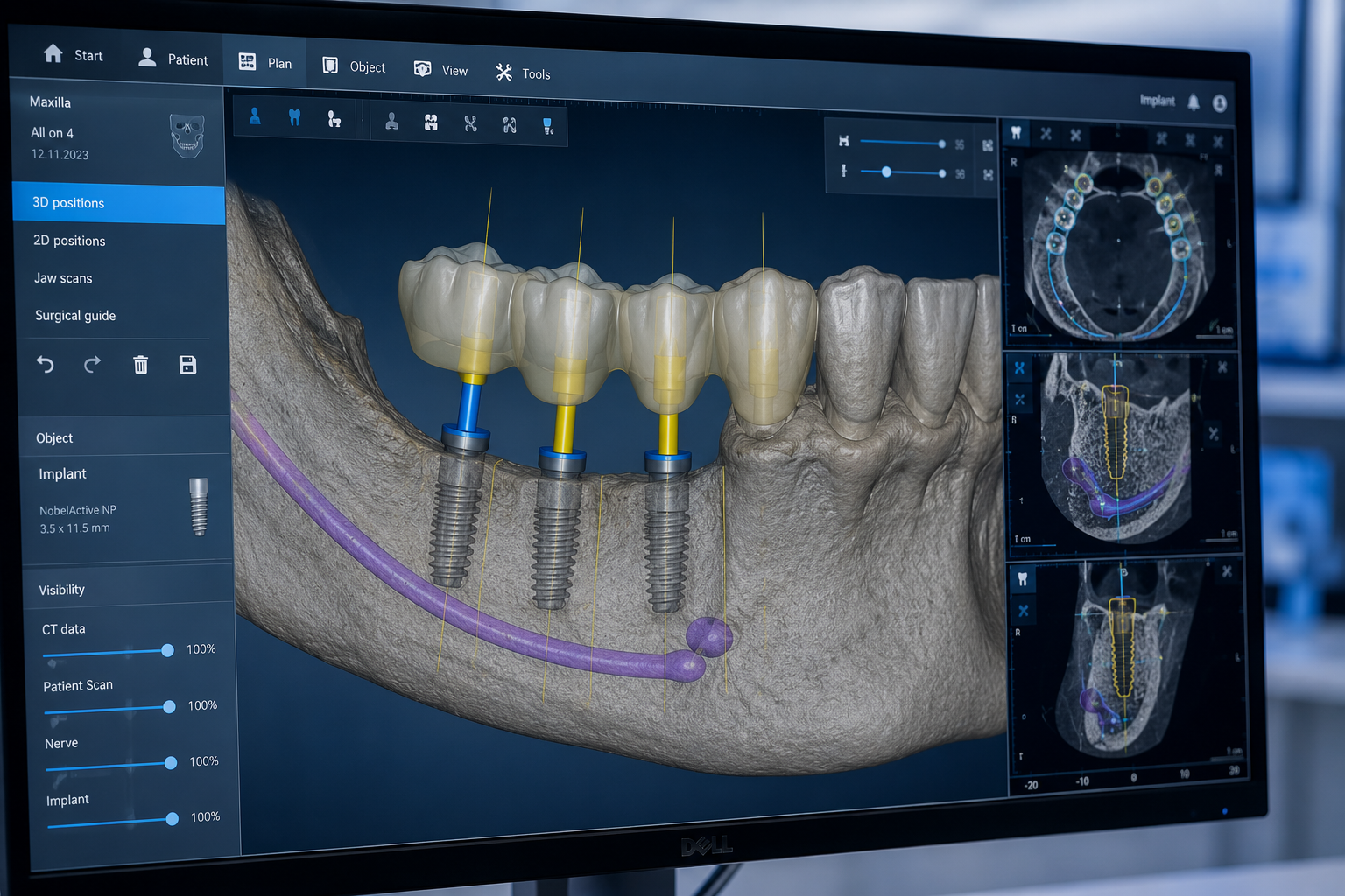 Implantes dentales con cirugía guiada en Llíria — Clínica Miguel Pérez Odontología