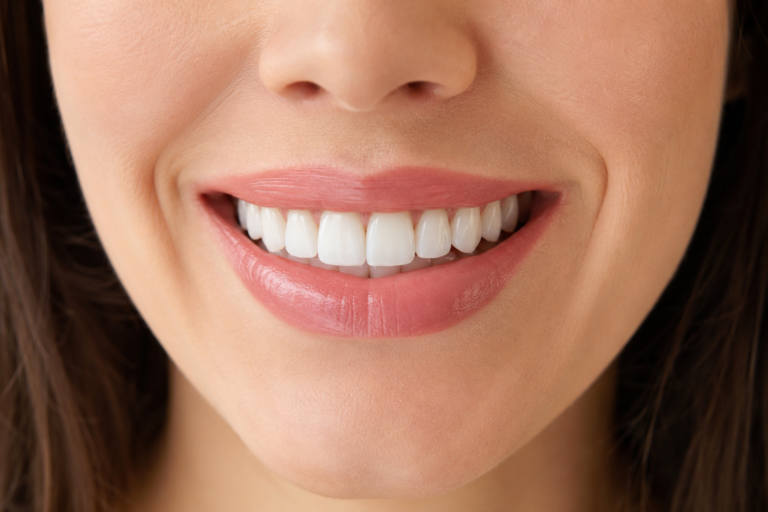 Carillas dentales de porcelana en Llíria — resultado natural en Clínica Miguel Pérez Odontología