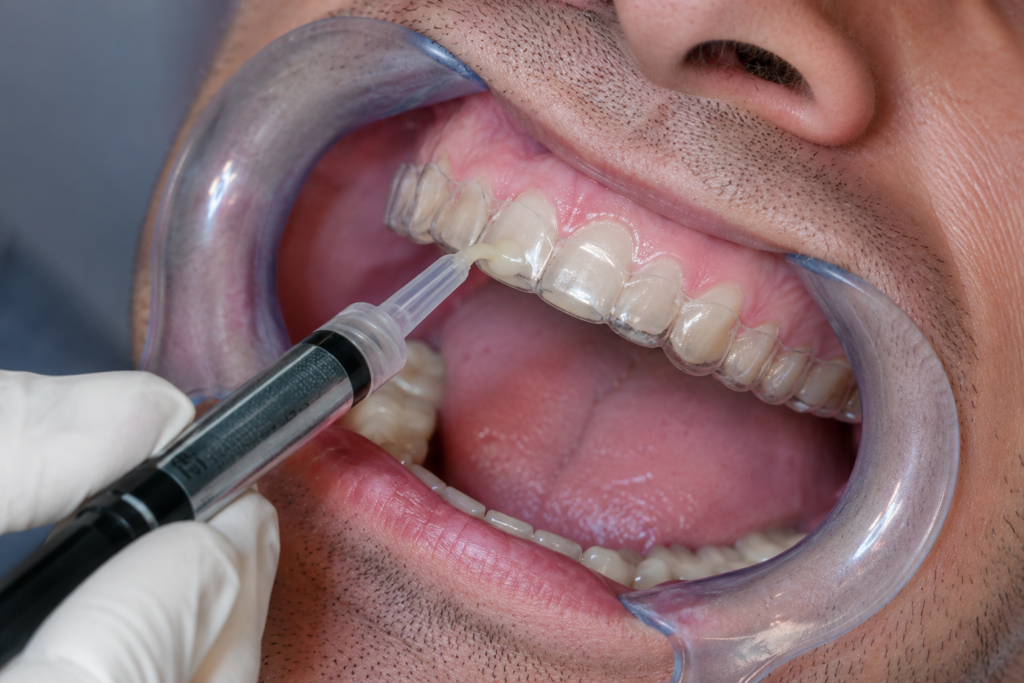 Proceso de inyección de resina compuesta a través de férula transparente para reconstrucción dental inyectada en Llíria.⁠