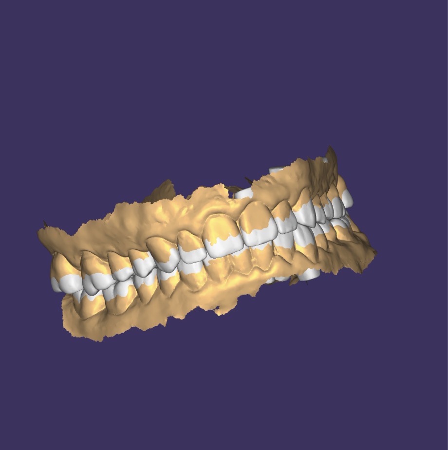 Diseño digital en Exocad del aumento de dimensión vertical en Clínica Miguel Pérez Odontología